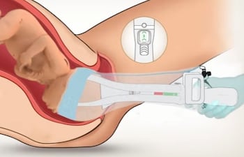 OdonAssist, herramienta para partos.