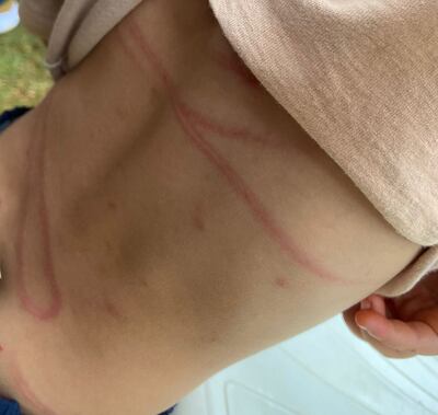 El niño quedó con rastros del castigo físico en varias partes del cuerpo.