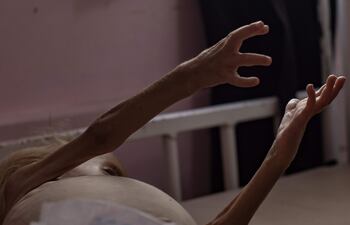 Gaza, 10/08/2025. Sham Qudeih, niño palestino de dos años, yace desnutrido en una cama en el Hospital Nasser en Khan Younis, en el sur de la Franja de Gaza. EFE/HAITHAM IMAD