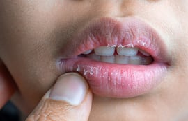 Concepto de labios secos.