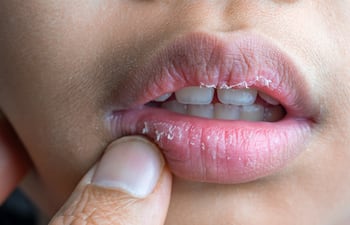 Concepto de labios secos.