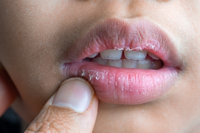 Concepto de labios secos.