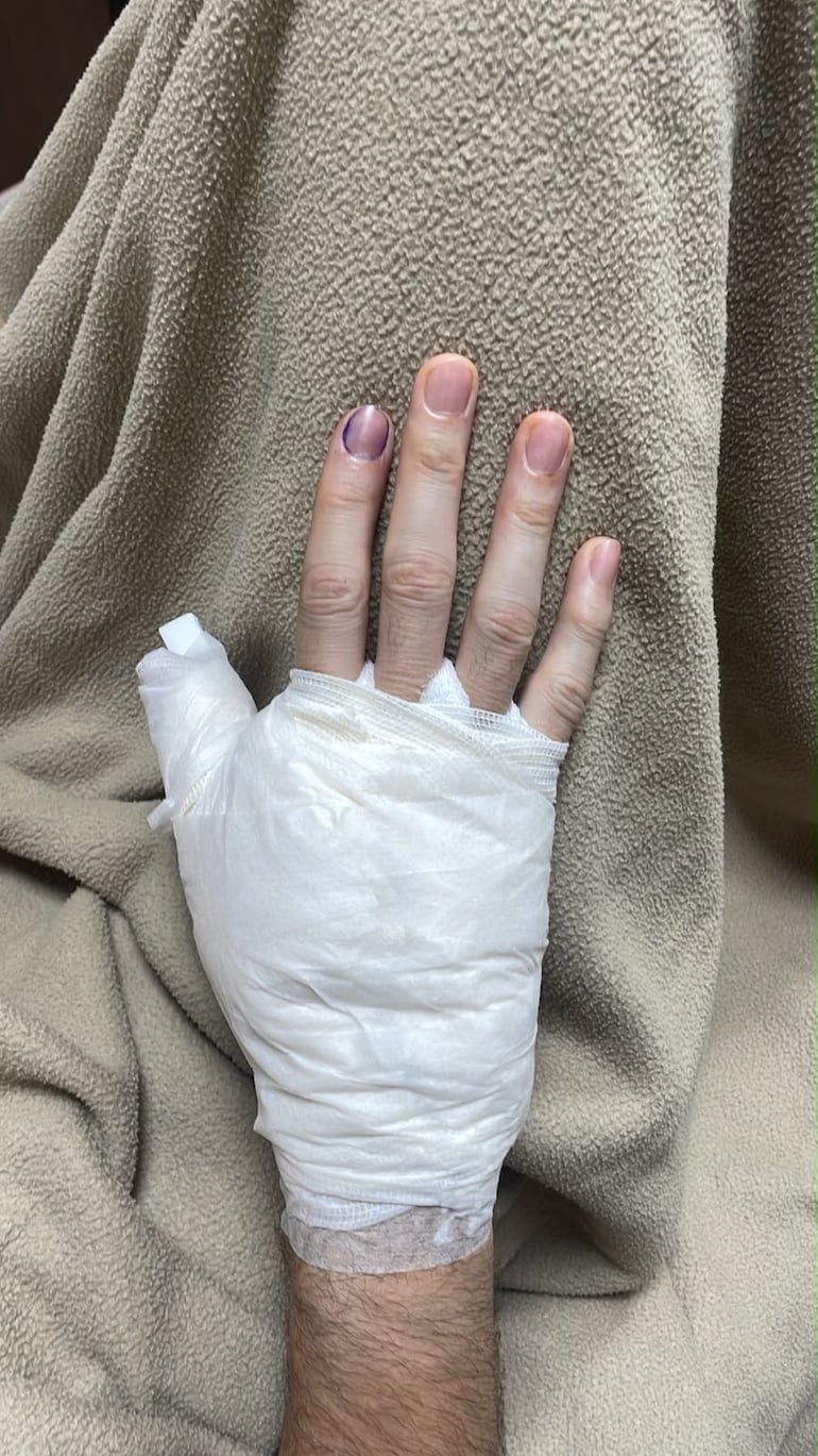 Mano lesionada de Gerardo Amílcar Ortiz Zarza, guardameta de Nacional.