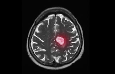 Una imagen de resonancia magnética (RM) en corte axial del cerebro que muestra un tumor grande. Concepto de cáncer primario o metástasis proveniente de otro órgano interno. Imagen ilustrativa.