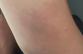 La mujer quedó con rastro de la agresión en uno de los brazos.