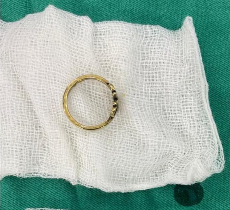 El anillo extraído del paciente.