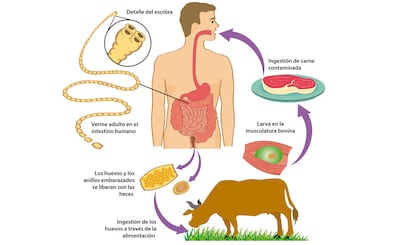 Infecciones parasitarias: teniasis.