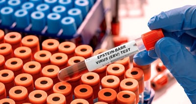 Tubos de prueba del virus de Epstein-Barr, imagen ilustrativa.
