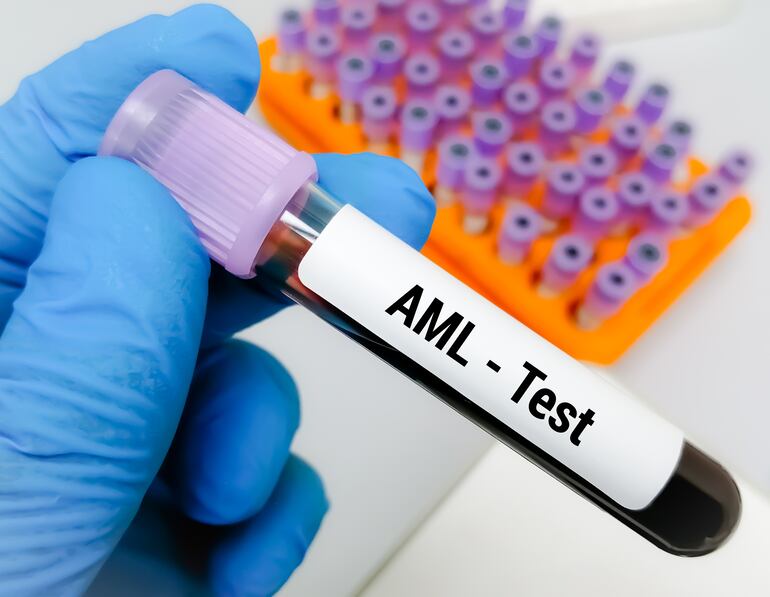 Muestra de sangre para la prueba de leucemia mieloide aguda (LMA)