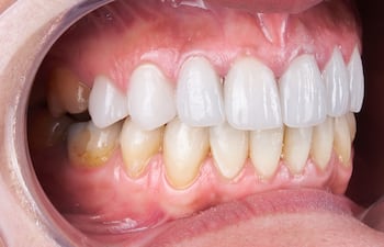 ¿Qué dice el color de tus dientes sobre tu salud?