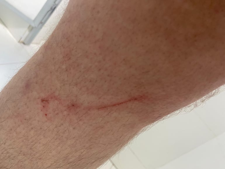 Ciclista cayó en un bache de la bicisenda de la calle Iturbe de Asunción, y quedó con heridas y la bicicleta dañada.