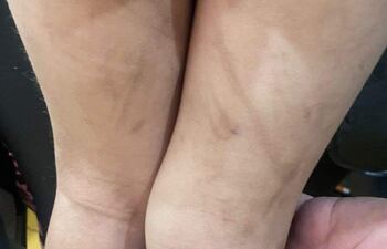 Rastros de brutales golpizas que recibía el niño de tres años, de parte del padre biológico y la madrastra, según denuncia hecha ante la fiscalía. Los supuestos autores ya están detenidos.