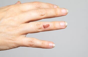 Streptococccus pyogenes