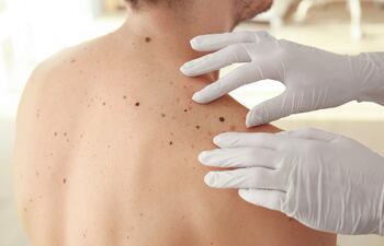 Los lunares, cronológicamente suelen presentarse en la infancia como manchas. Durante el crecimiento estos lunares pueden aumentar en diámetro y altura, en relación proporcional al mayor volumen corporal. Este hecho también se observa en la pubertad y en el embarazo.