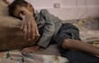 Un niño palestino de cinco años con desnutrición severa en un hospital en Jan Yunis, en el sur de la Franja de Gaza.