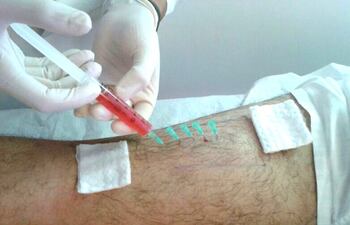 En el Hospital de Clínicas se está realizando la extracción de plaquetas por aféresis gracias a la donación voluntaria de pacientes sanos.