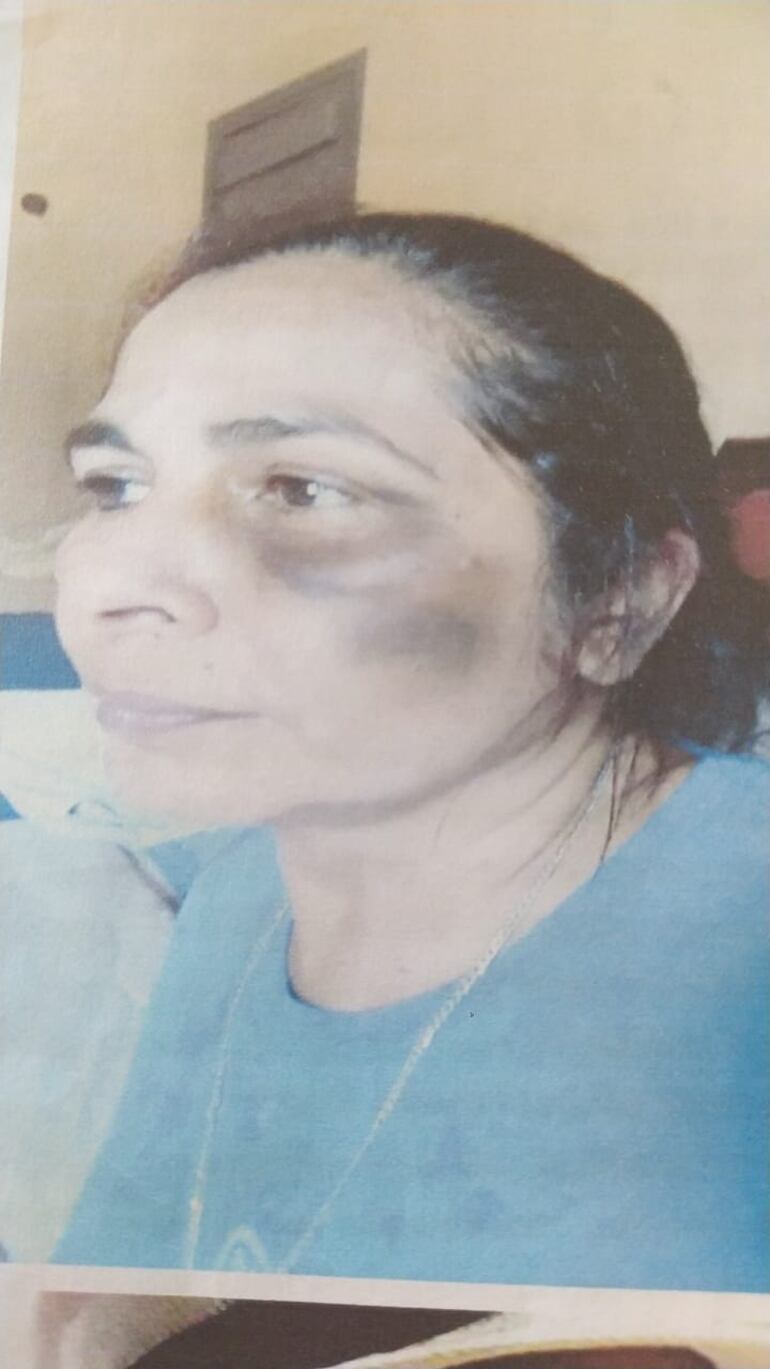 Aida Sosa muestra como quedó su rostro luego de la agresión.