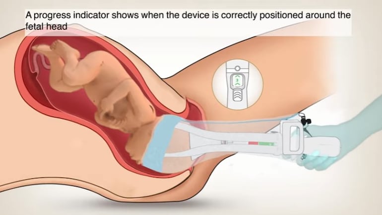 OdonAssist, herramienta para partos.