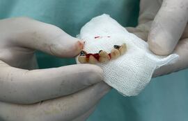 Equipo de médicos del Ineram que extrajo cinco dientes del pulmón de un paciente.