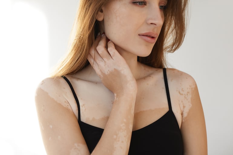 Vitiligo.
