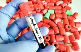 Test para detectar la Amiloidosis.