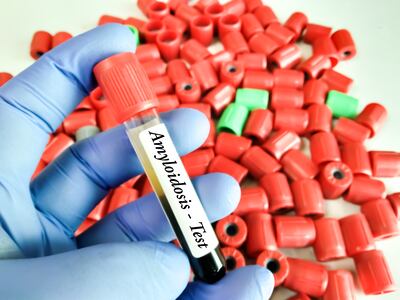 Test para detectar la Amiloidosis.