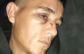 De esta manera quedo el rostro de Matías Aile Rivarola, cuya madre denuncio de abuso de poder por la Policía Nacional posterior a su detención.