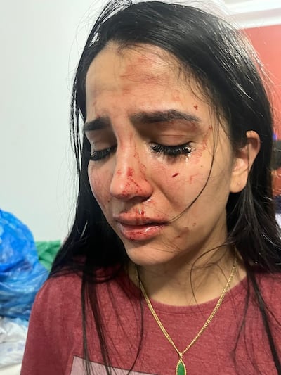 El rostro ensangrentado de la modelo Fiorella Zaracho, víctima de presunta agresión por parte de un hombre identificado como funcionario del Poder Judicial.
