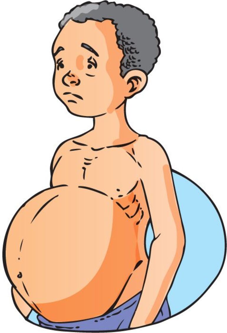 Uno de los síntomas es el aumento del abdomen.