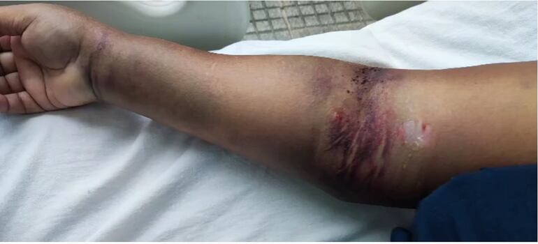 Estado en que quedó el brazo de Nilsa Diaz de Narváez, cuya familia denuncia maltratos en IPS Ingavi.