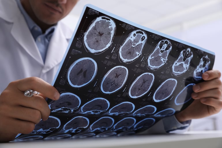 Médico analiza un estudio de una persona con esclerosis múltiple.