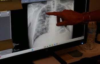 Lisa Emery, directora del Centro Respiratorio y la Clínica de Pulmón Negro de New River Health, muestra una radiografía de los pulmones de un minero que padece la enfermedad del pulmón negro, en el Centro de Salud New River, en Oak Hill, Virginia Occidental, el 13 de agosto de 2026.