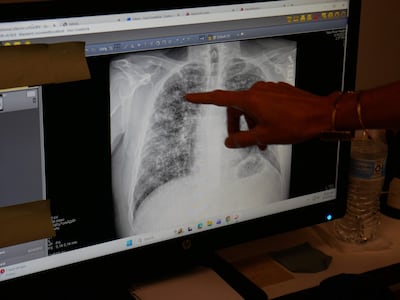 Lisa Emery, directora del Centro Respiratorio y la Clínica de Pulmón Negro de New River Health, muestra una radiografía de los pulmones de un minero que padece la enfermedad del pulmón negro, en el Centro de Salud New River, en Oak Hill, Virginia Occidental, el 13 de agosto de 2026.