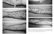 Documentación de procedimiento médico de fasciotomía en extremidad superior, mostrando herida y tratamiento aplicado.