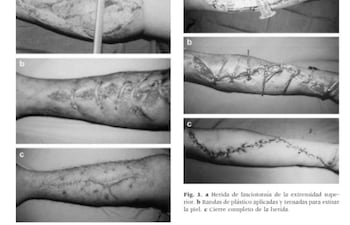 Documentación de procedimiento médico de fasciotomía en extremidad superior, mostrando herida y tratamiento aplicado.