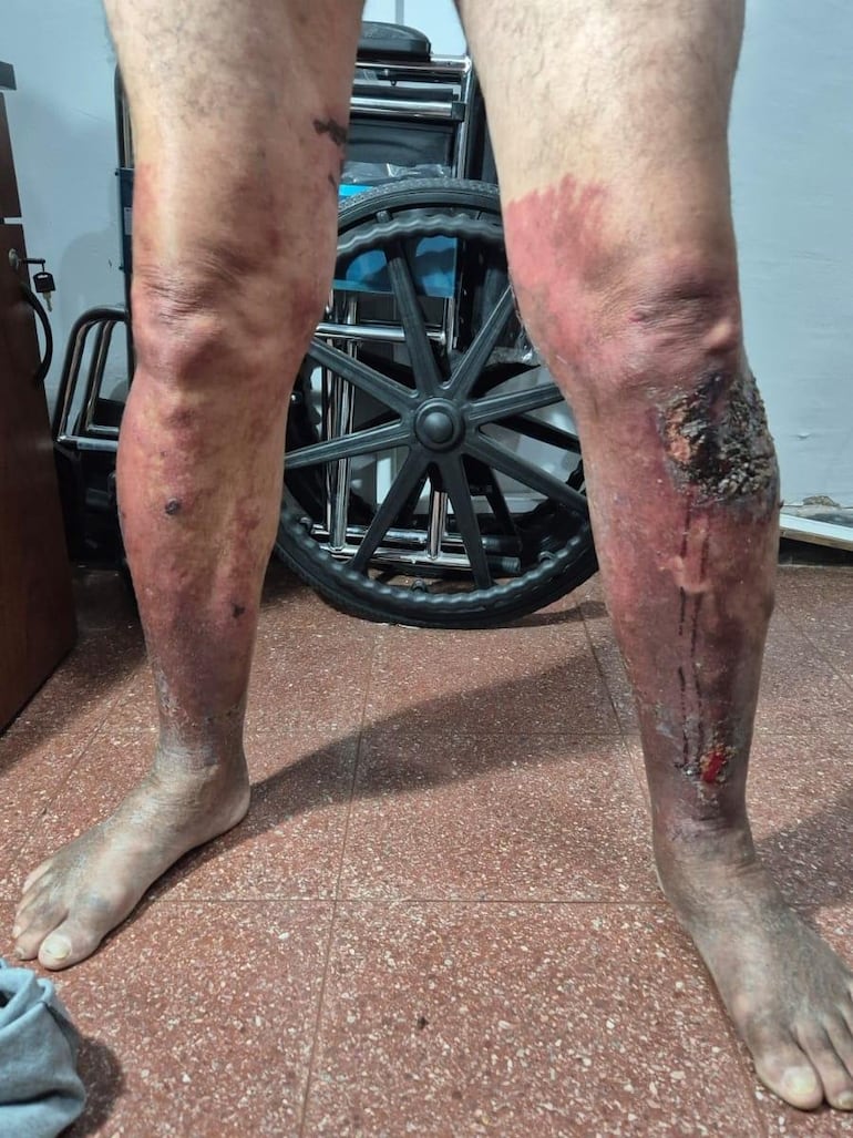 Las quemaduras que sufrió Luis Carlos Ferreira Martínez cuando supuestamente quemó el auto con uno de los cuerpos adentro.