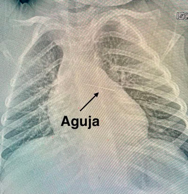 Radiografía de la aguja dentro del sistema de la niña. Facebook: Carlos Morínigo.