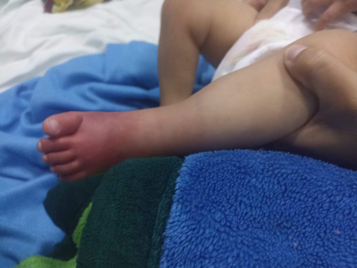 Instituto de Medicina Tropical: familiares preocupados por operación de pie de una bebé