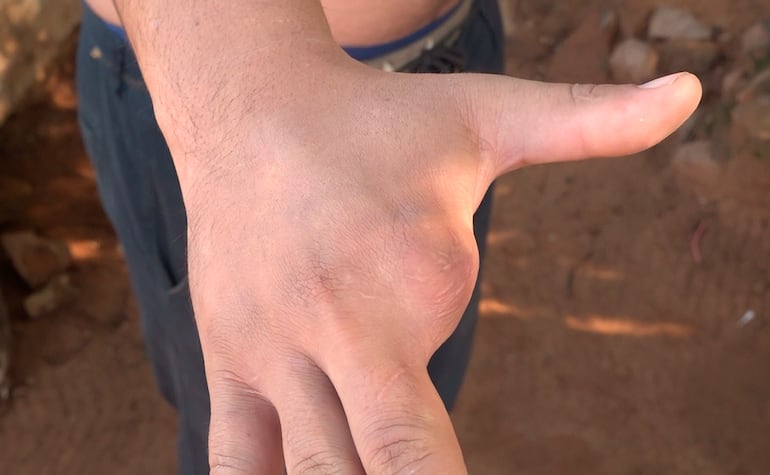 Así quedó la mano de Cristhian Otazú, tras el brutal ataque que sufrió eñ 9 de marzo pasado, en Ñemby.