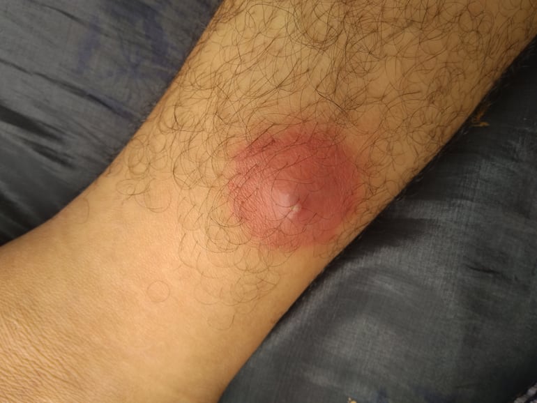 Forúnculo. Imagen ilustrativa.