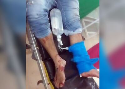 El hombre fue asistido en el Centro de Salud de Minga Porã a raíz de una herida de bala en la pierna.