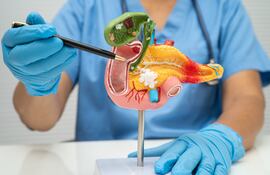 Pancreatitis, cáncer de páncreas, médico con un modelo de páncreas, vesícula biliar y conducto biliar.
