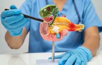 Pancreatitis, cáncer de páncreas, médico con un modelo de páncreas, vesícula biliar y conducto biliar.