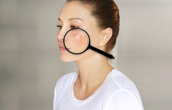 El lupus puede notarse por una erupción en las mejillas y el puente nasal.