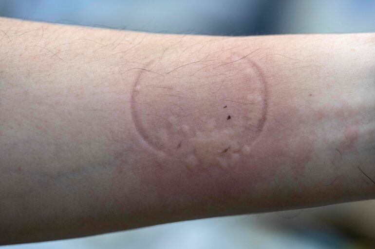 Un investigador exhibe erupciones (o sarpullido) después de permitir que chinches de cama se alimentaran de su brazo como parte de un estudio científico en un laboratorio de la Universidad de Ciencias de Malasia (USM) en George Town, en la isla de Penang.