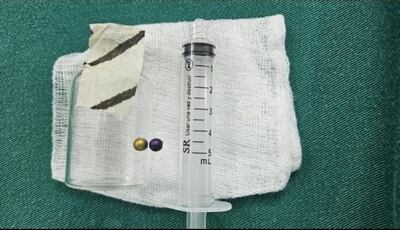 Extraen perlas de un collar del organismo de una niña de cuatro años.