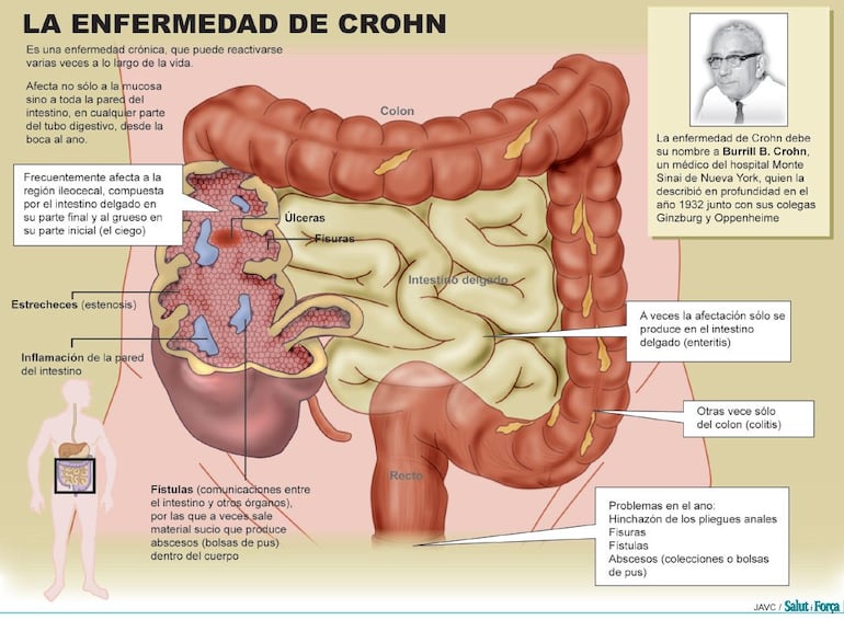 Enfermedad de Crohn. 