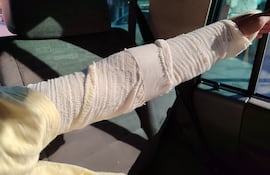 El brazo izquierdo del niño de 12 años acusó una fuerte lesión como consecuencia de la brutal golpiza que fue sometido con un palo de escoba.