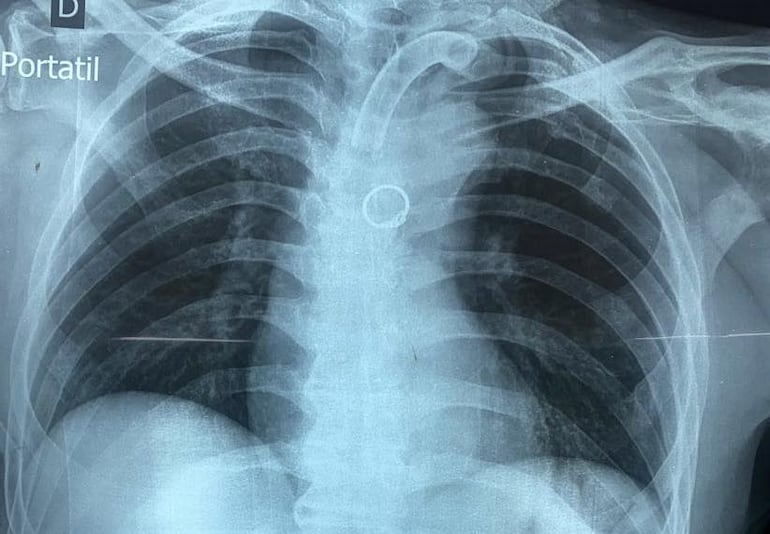 Radiografía practicada al paciente donde se observa el anillo.