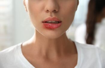 Herpes labial, imagen ilustrativa.